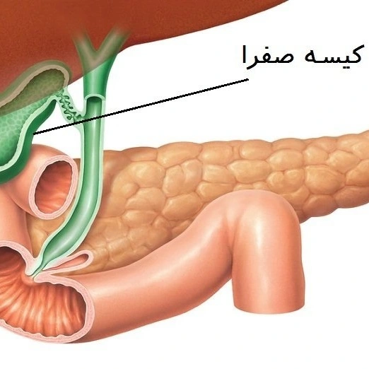 سونوگرافی سادهترین روش تشخیص سنگ صفرا