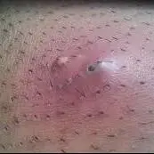 رویش موی زیرپوستی از عوارض لیزر موی زائد